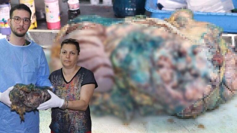 Il y est allé avec une plainte de douleurs abdominales !  Même les médecins ont été choqués : une tumeur géante de 10 livres