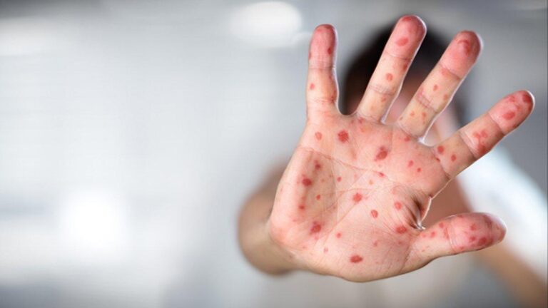 Prof. Dr. Déclaration de Mehmet Ceyhan sur le virus de la variole du singe : cela m'a rappelé le coronavirus